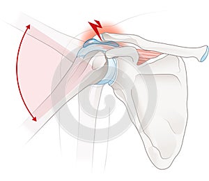 Shoulder impingement photo