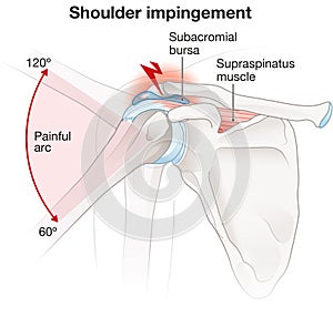 Shoulder impingement, labeled photo