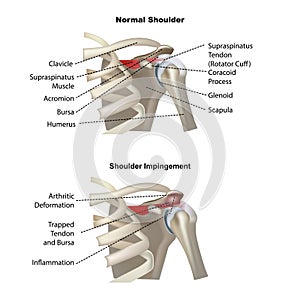 Shoulder impingement, , medical posters with symbols, vector illustration photo