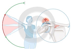 Shoulder impingement. Painful arc. Labeled illustration