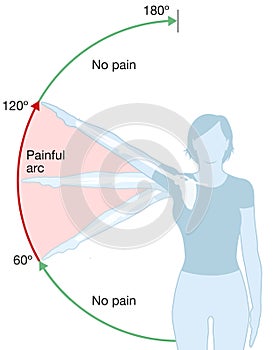 Shoulder impingement. Painful arc. Labeled illustration