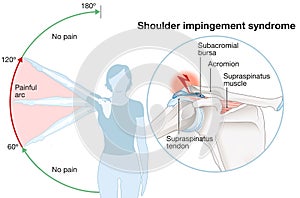 Shoulder impingement. Painful arc. Labeled illustration photo