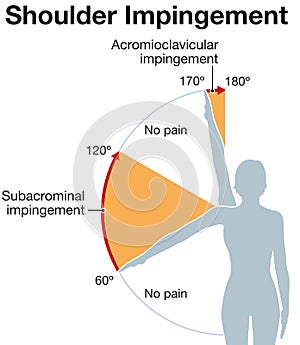 Shoulder impingement. Painful arc. Labeled Illustration photo