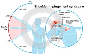 Shoulder impingement sydrome. Painful arc. Labeled Illustration