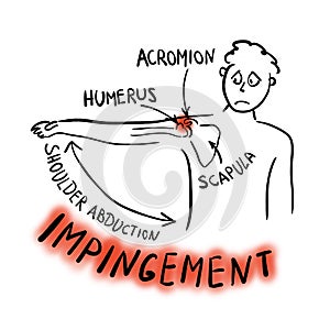 Shoulder impingement syndrome. Painful abduction photo