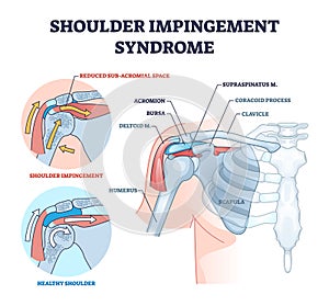 Shoulder impingement syndrome from rubbing rotator cuff outline diagram photo