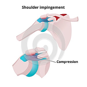 Shoulder impingement vector illustration. Illustration of the muscle tendon and bursa compression