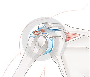 Shoulder joint. Calcific tendinitis and bursitis photo