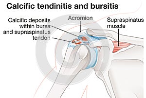 Shoulder joint. Calcific tendinitis and bursitis photo