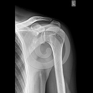 Shoulder joint x-ray image AP view