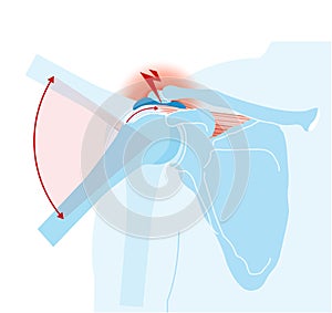 Shoulder joint. Shoulder impingement. Labeled Illustration