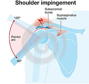 Shoulder joint. Shoulder impingement. Labeled Illustration