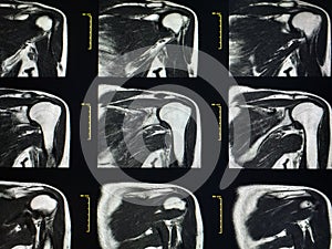 Shoulder MRI Scan Magnetic Resonance Image High Resolution