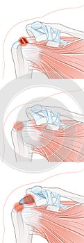 Shoulder pain. Rotator cuff tear, rotator cuff tendonitis, shoulder bursitis_2