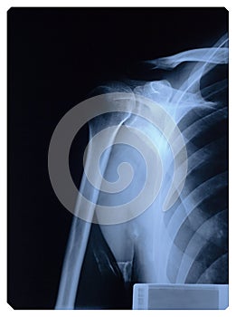 Shoulder X-ray