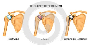 Shoulder replacement. surgery