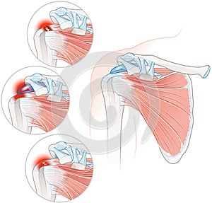 Shoulder Rotator Cuff Disease Illustration. Labeled