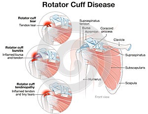 Shoulder Rotator Cuff Disease Illustration. Labeled