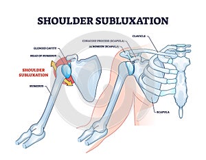 Shoulder subluxation as partial dislocated arm joint problem outline diagram photo