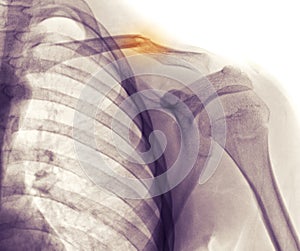 Shoulder x-ray, clavicle img