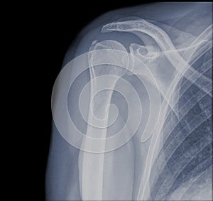 Shoulder x-ray isolated img