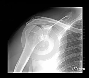 Shoulder xray