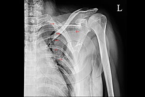 A shoulder xray film showing fractured second to to fifth ribs with fracture scapular blade