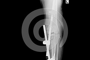 X-ray image of fracture leg with implant external fixation.