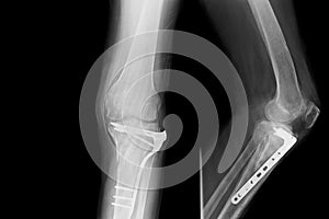 Show image of x-ray both leg and show external fixation of them