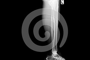 Show image of tibia and fibula left lateral
