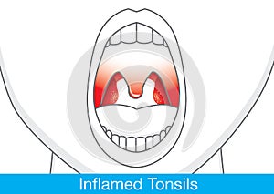 Showing Inflamed tonsils.