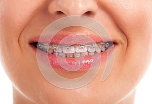 Showing white teeth with braces