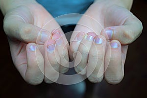 Shows the characteristic of bitten and dirty nails, which require urgent treatment, dirty nails can cause serious contagious disea