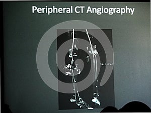 Shrapnel arterial injuries from Hamas rocket explosions