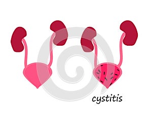 Sick bladder on a white background. Cystitis. Symbol. Vector