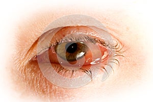 sick eye with Conjunctivitis