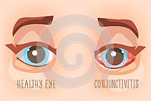 Sick eyes, eye conjunctivitis. Eyecare illustration