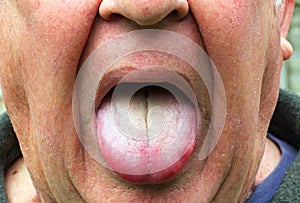 Sick or ill man, coated yellow tongue.