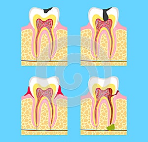 Sick Teeth - caries, periodontal disease, pulpitis. branch of medicine stomatology. pathology of teeth