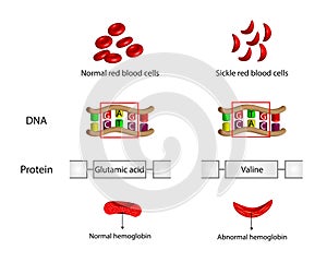 Sickle cell anemia, disease. Normal and sickled red blood cells. photo