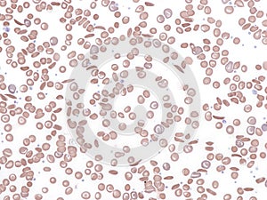 Sickle cell anaemia. Peripheral blood photo
