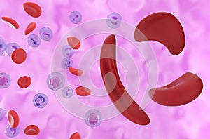 Sickle cell Anaemia Sickle cell disease SCD cells in the blood flow - super closeup view 3d illustration