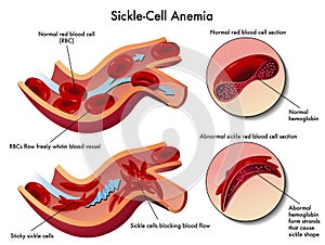 Srp buňka anémie 