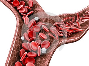 Sickle cell anemia, 3D illustration showing blood vessel with normal and deformed crescent isolated white