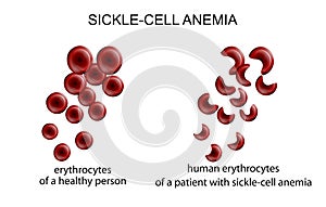 Sickle cell anemia