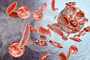 Sickle cell anemia