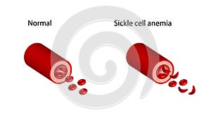 Sickle cell anemia, disease. Normal and sickled red blood cells.
