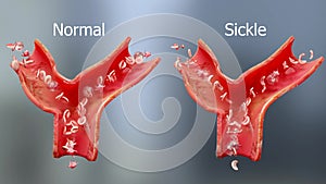 Sickle cell anemia disease, sicklecell, blood vessel with normal red blood cells and sickled red blood cells