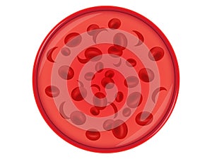 Sickle cell anemia photo