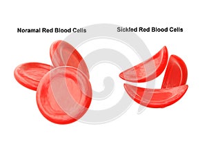 Sickle cell anemia is a hereditary disease characterized by the alteration of red blood cells, making them look like a sickle
